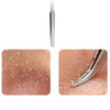 Acne Clip Tweezer - Pimple Comedone Remover Kit